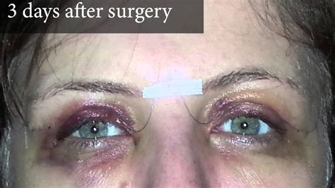 upper eyelid surgery photos of a real patient and video