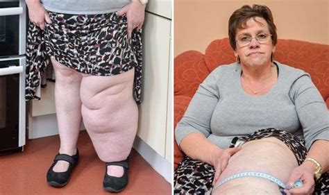 Cancer Survivor With One Leg Three Stone Heavier Than The Other Refused