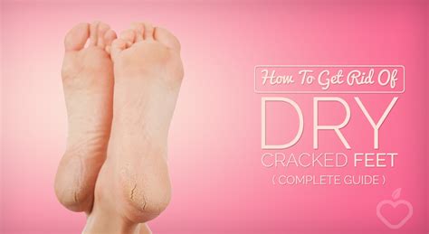 How To Get Rid Of Dry Cracked Feet [guide]