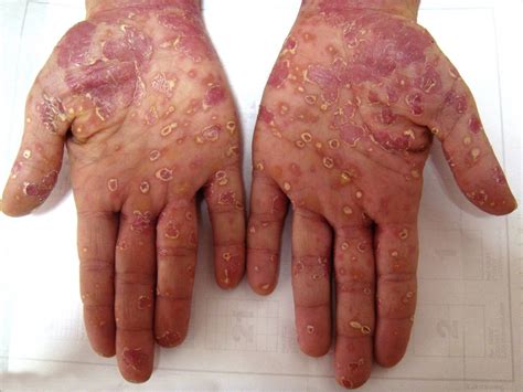 Secondary Syphilis Presenting As Rash And Annular