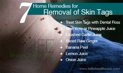 7 home remedies to remove skin tags
