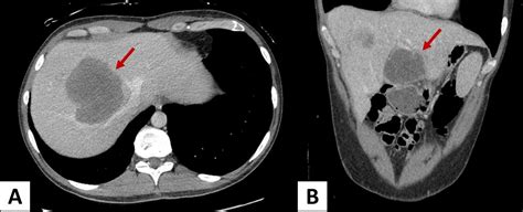 Bilateral Liver Metastases From Testicular Sex Cord Stromal Tumour