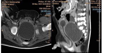 anterior rectal duplication cyst a rare case report