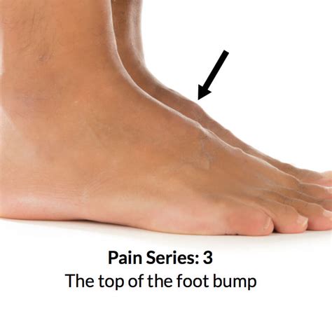 foot bump  top   foot consulting footpain