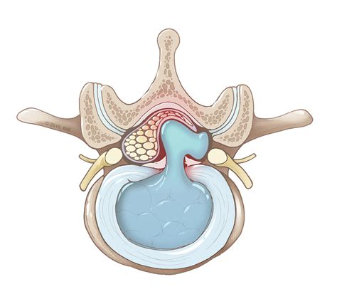 disc herniation barrow neurological institute