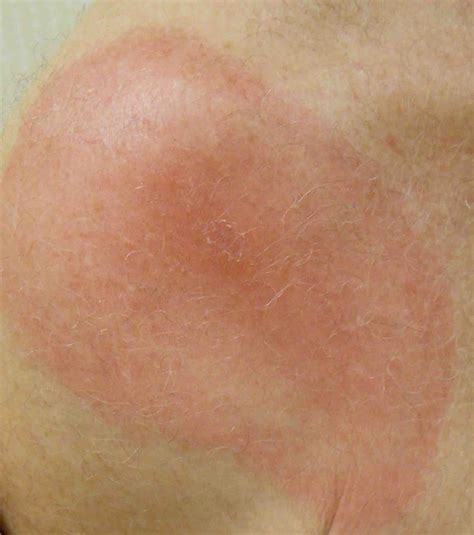 deep machine learning   accurately identify erythema migrans
