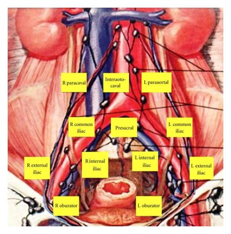 Template Of Extended Lymph Node Dissection During Radical Cystectomy