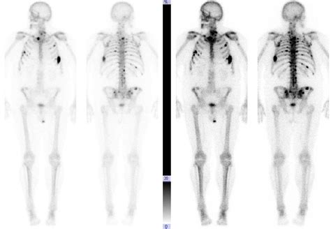 prostate cancer bone metastases  months   meta radiology