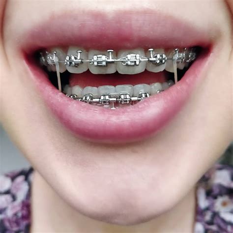 pin by jamie richie on braces and retainers orthodontics cute braces