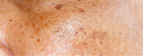 brown skin spots    worry   brown spots   skin