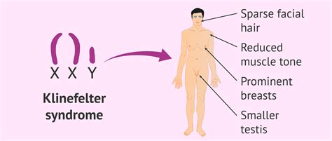 Klinefelter Syndrome All You Need To Know – Sdlgbtn 56 Off