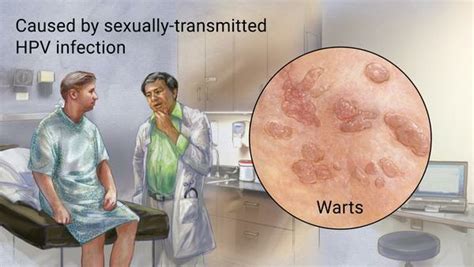 what are the symptoms of genital warts those who do not find time for