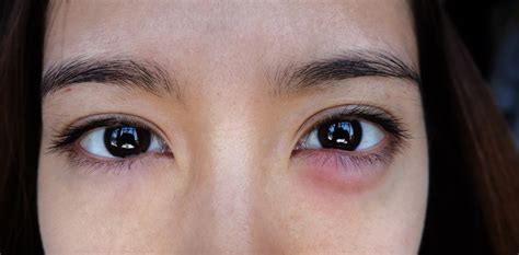 reasons   eyelids  swollen healthy builderz
