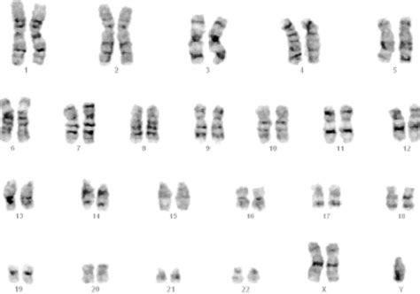 Karyotype Of Klinefelters Syndrome Patient Showing 47 Xxy Download