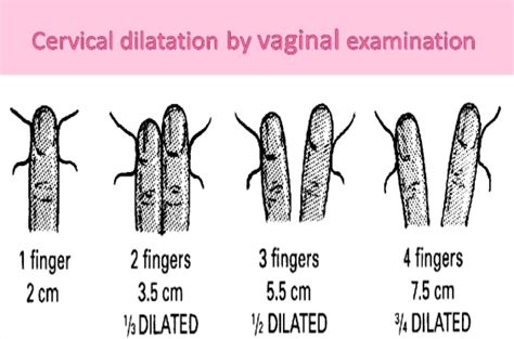 cervical dilation stepwards