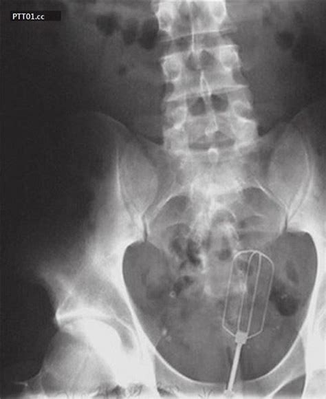 Funny X Ray Images 30 Of The Most Unbelievably Weird X Rays You`ll