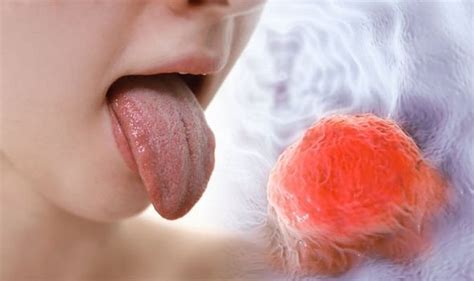 tongue cancer symptoms to indicate you could have the disease