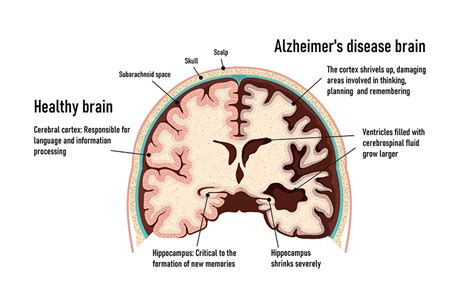 neuropathological   alzheimers disease ad