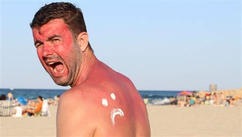 how to get rid of sunburns fast with home remedies and treatments