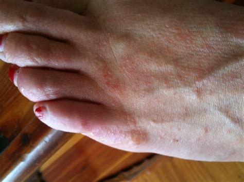 itchy bumps on feet causes pictures and treatment