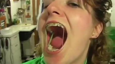 mouth tongue fetish hot girl braces with elastics porn videos