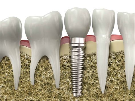 simple guide  finding dental implants