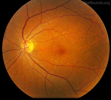 age related macular degeneration typically affects  central portion   eye
