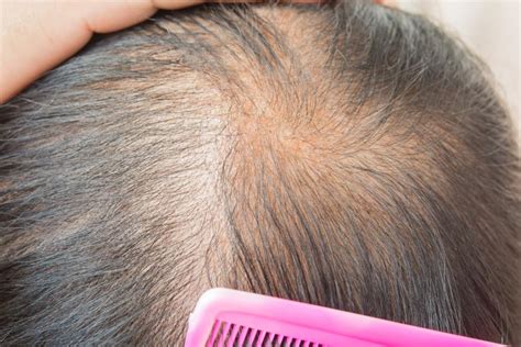 thinning hair  types treatment  remedies