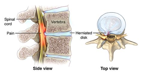 Lumbar Spinal Stenosis Cedars Sinai