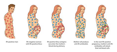 understanding fetal anemia maternal fetal medicine  nyc
