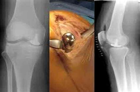 Dr Ashok Rajgopal Top Minimally Invasive Knee Surgeon In