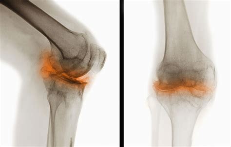overview  osteoarthritis  pictures