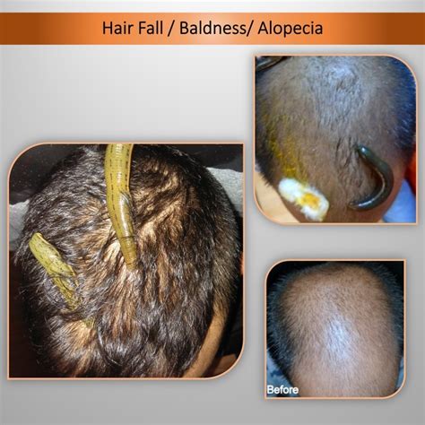 remove baldness by ayurveda hair oils herbal treatment to baldness