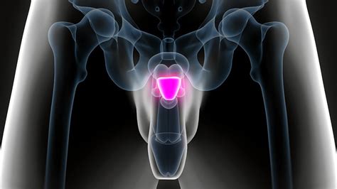 good qol but sexual dysfunction common after prostate cancer