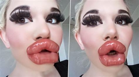 woman shows off her ‘post procedure lips following 20th lip injection