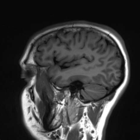 normal brain mri radiology case radiopaediaorg mri mri brain