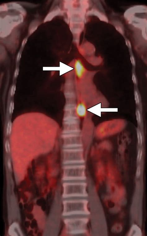 New Tnm Staging System For Esophageal Cancer What Chest Radiologists