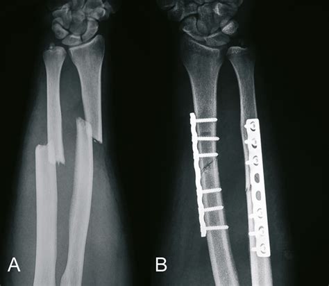 orthoforum unterarmfraktur