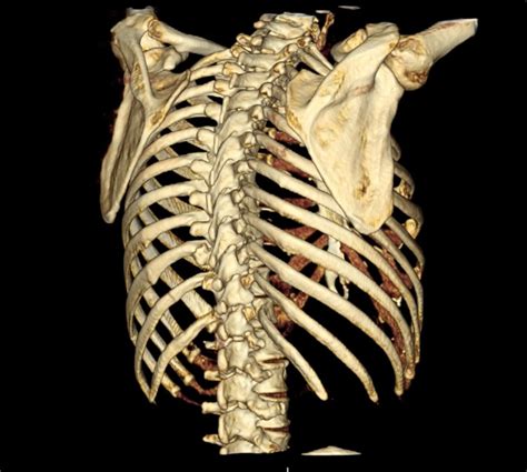 rekonstruktion einer ct des thorax mit ansicht von dorsal mit