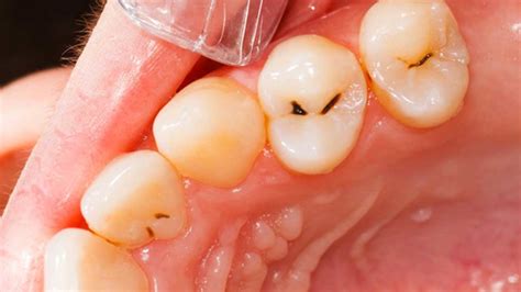 finding   material  filling  tooth cavity west hollywood