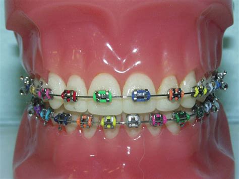 braces kifer dental specialist dr denise doan dds mmsc