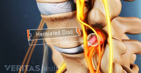 cervical herniated disc symptoms and treatment options