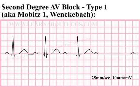 degree av block type  ecg strip  electrocardiology