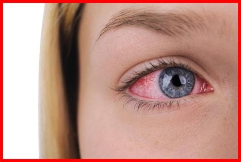 os  remedios caseiros  tratar olhos vermelhos dicas de saude