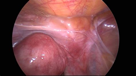 Fibroid Uterus Retroverted Uterus Ventrosuspension Infertility