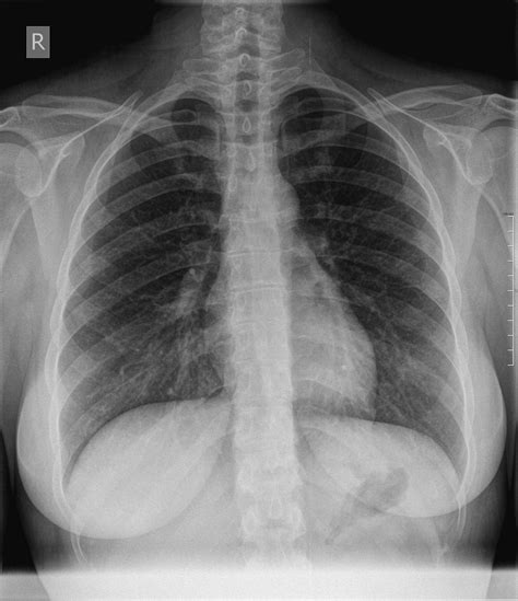 kann man eine lungenembolie beim thorax roentgen erkennen
