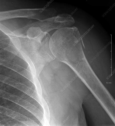shoulder fracture x ray stock image c039 3348