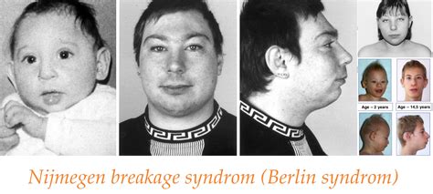 nijmegen breakage syndrom priznaky projevy symptomy pricina lecba fotografie obrazek