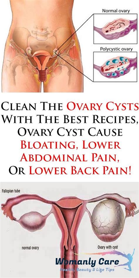 Pin On Cyst On Ovary