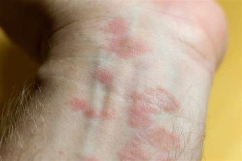 pink spots  skin   treatments skin care geeks